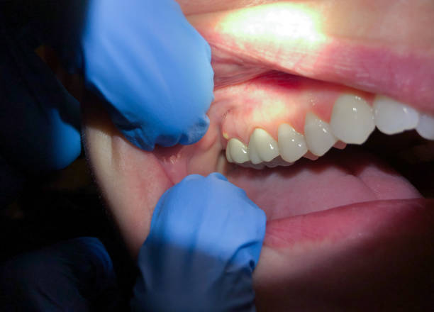 Best Emergency Dental Care for Sports Injuries in Arcadia, LA